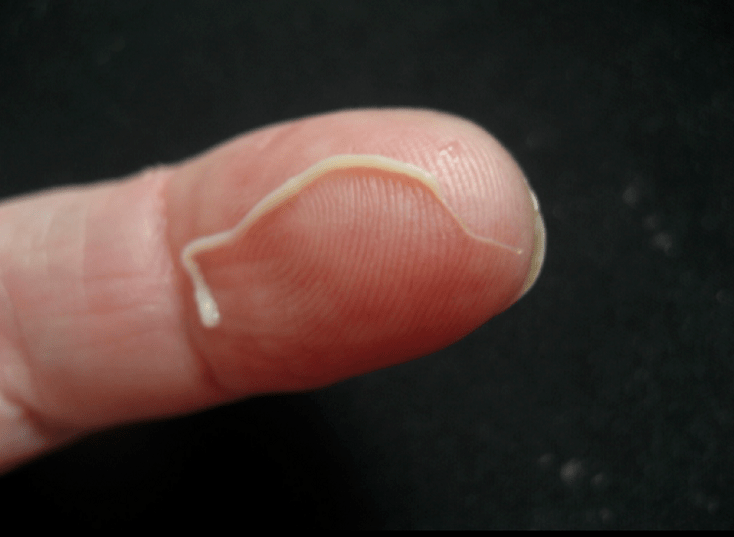 მრგვალი ჭიის პარაზიტი ადამიანის ორგანიზმიდან